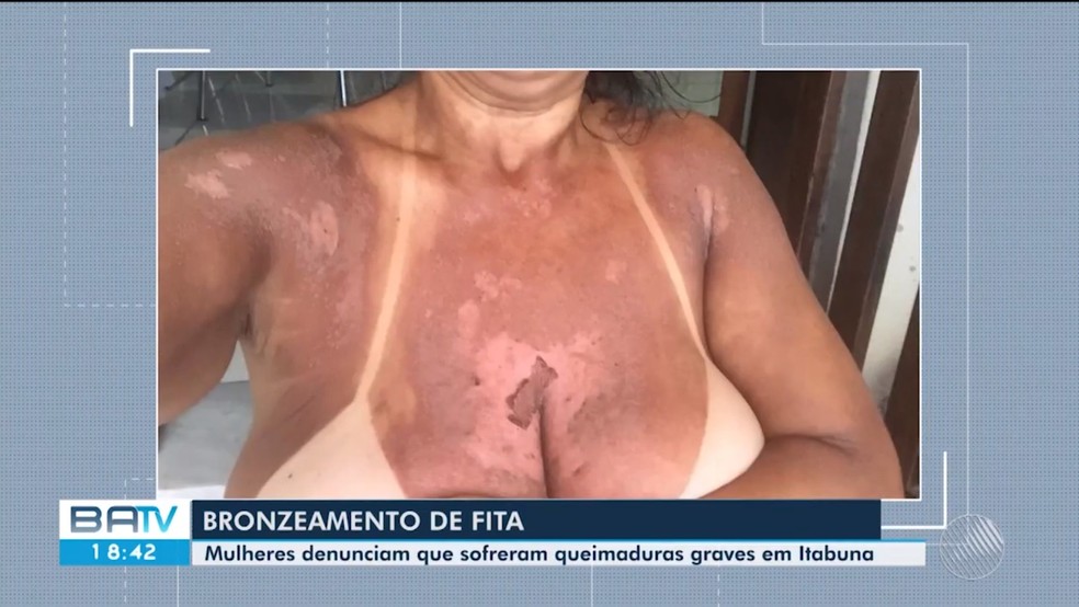 Vitima De Queimadura Durante Bronzeamento Natural Com Fitas Na Ba Fala Sobre Constrangimento Agressao Fisica Sem Assistencia Bahia G1
