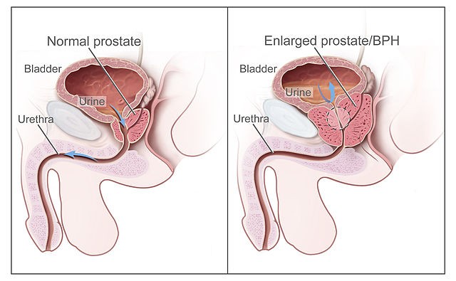 Câncer de próstata pode ter relação com bactérias (Foto: Wikimedia Commons)