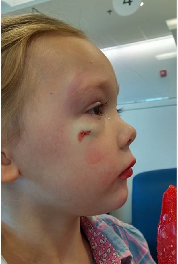 Filha de Merritt com o rosto machucado (Foto: Facebook)