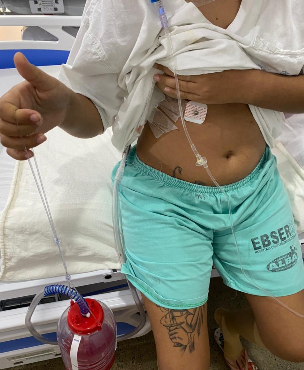A jovem está usando dreno devido à cirurgia — Foto: Lívia Monteiro/Arquivo pessoal