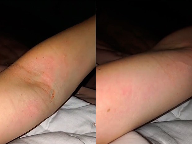 Suzanne Riediger mostra as marcas que teriam ficado em seu braço após as agressões (Foto: Reprodução/Instagram)