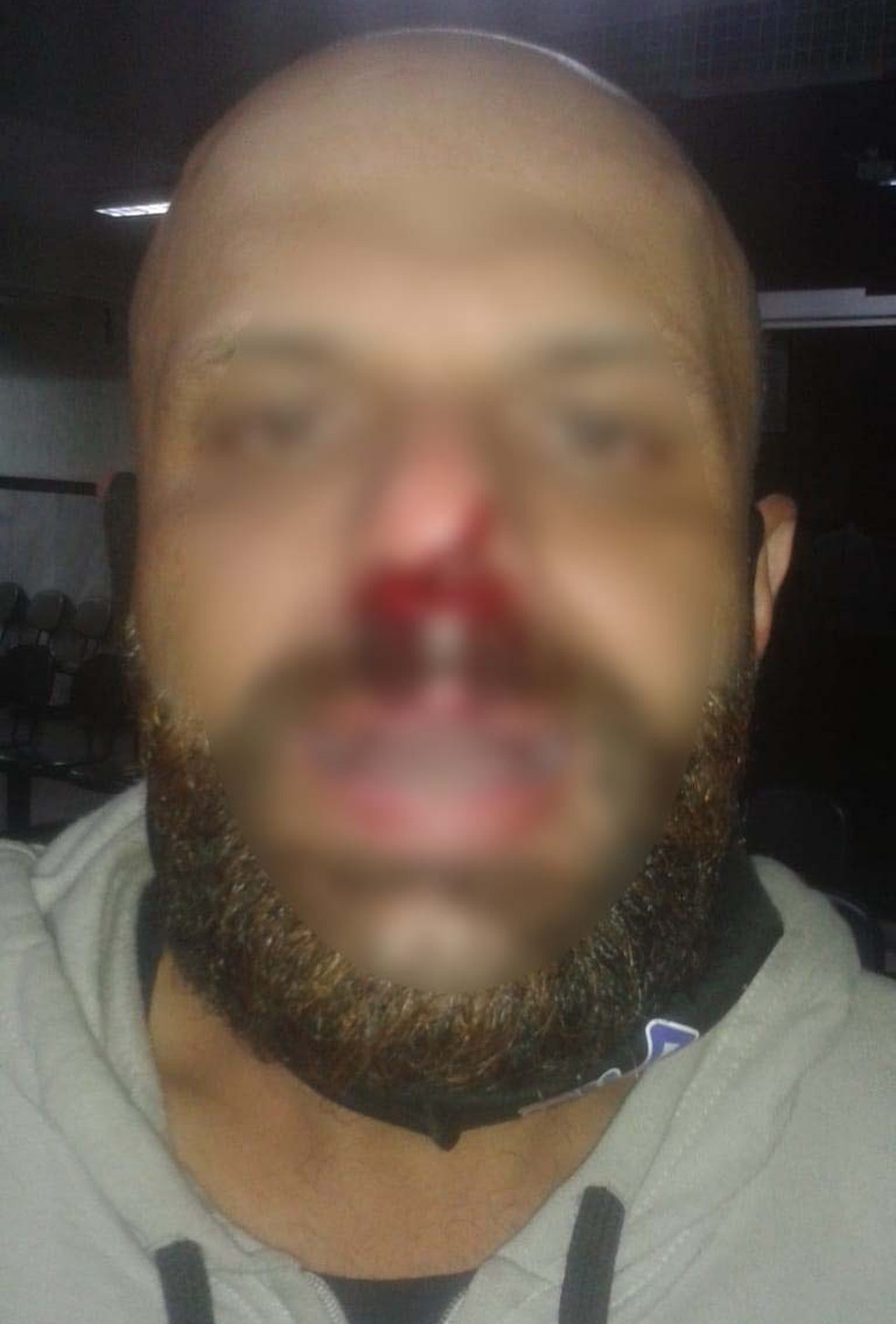 Vigilante afirma que ficou com nariz bastante ferido e perdeu um dente devido a agress&atilde;o em Praia Grande, SP &mdash; Foto: Arquivo Pessoal