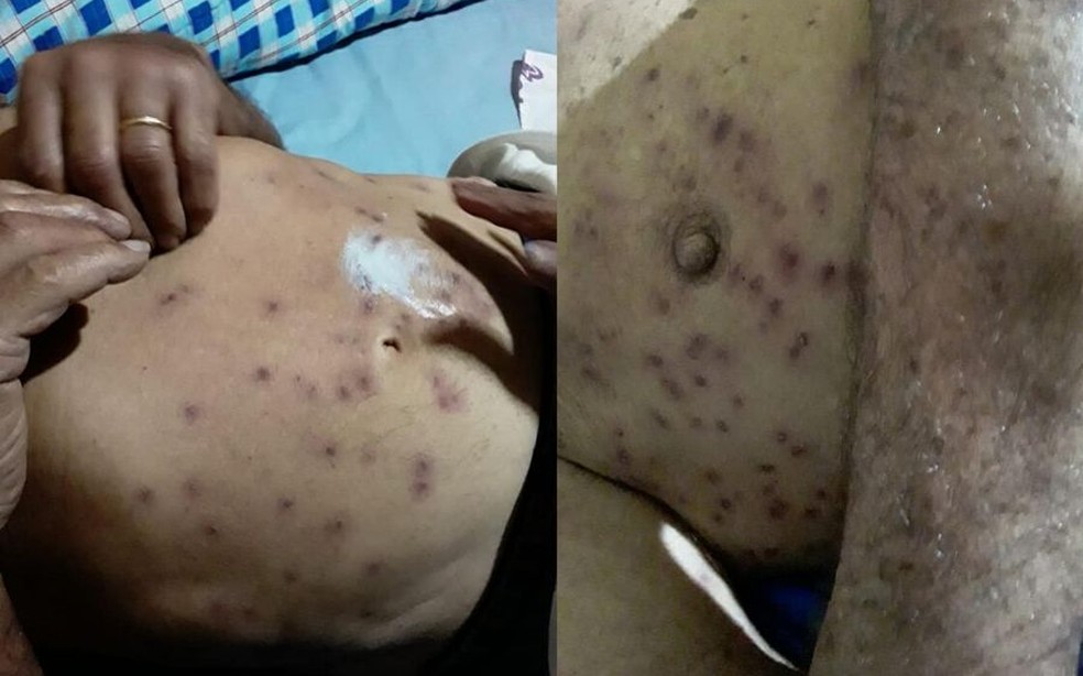 Idoso foi picado em várias partes do corpo e precisou ser socorrido a uma unidade de saúde — Foto: Arquivo Pessoal