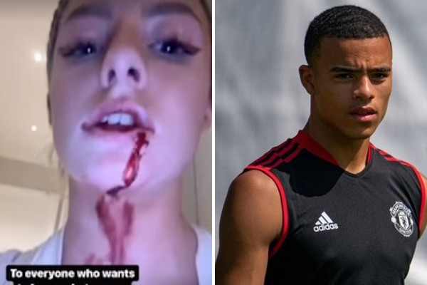 A modelo Harriet Robson com o rosto sangrando; e seu namorado, o jogador do Manchester United Mason Greewood (Foto: Instagram)