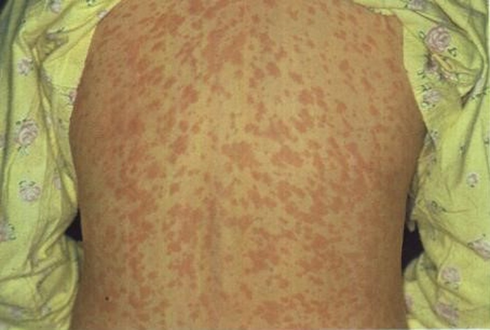 Manchas vermelhas pelo corpo podem aparecer em pessoas que contraíram sarampo — Foto: Divulgação/Sesa-ES