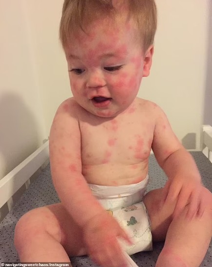 Menino é diagnosticado com doença de pele rara (Foto: Reprodução/DailyMail)