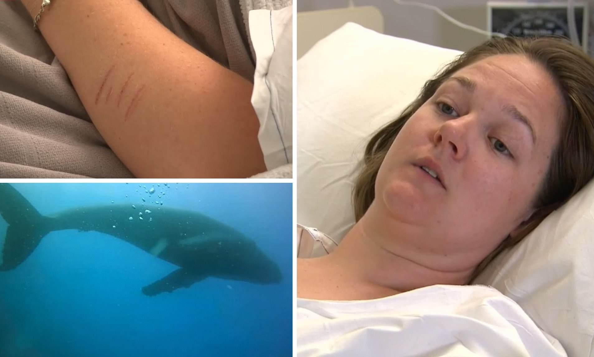 Alicia Ramsay, de 30 anos, foi levada de avião para o hospital Royal Perth com fraturas nas costelas na quinta-feira, 6, após ser atingida pela baleia (Foto: Reprodução)