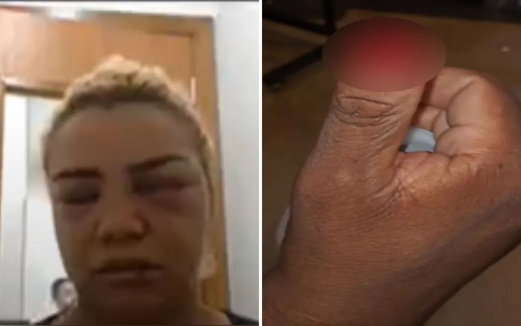 MP pede soltura de jovem que arrancou parte do dedo de policial durante abordagem: 'Feição da conduzida evidencia a prática de agressões'