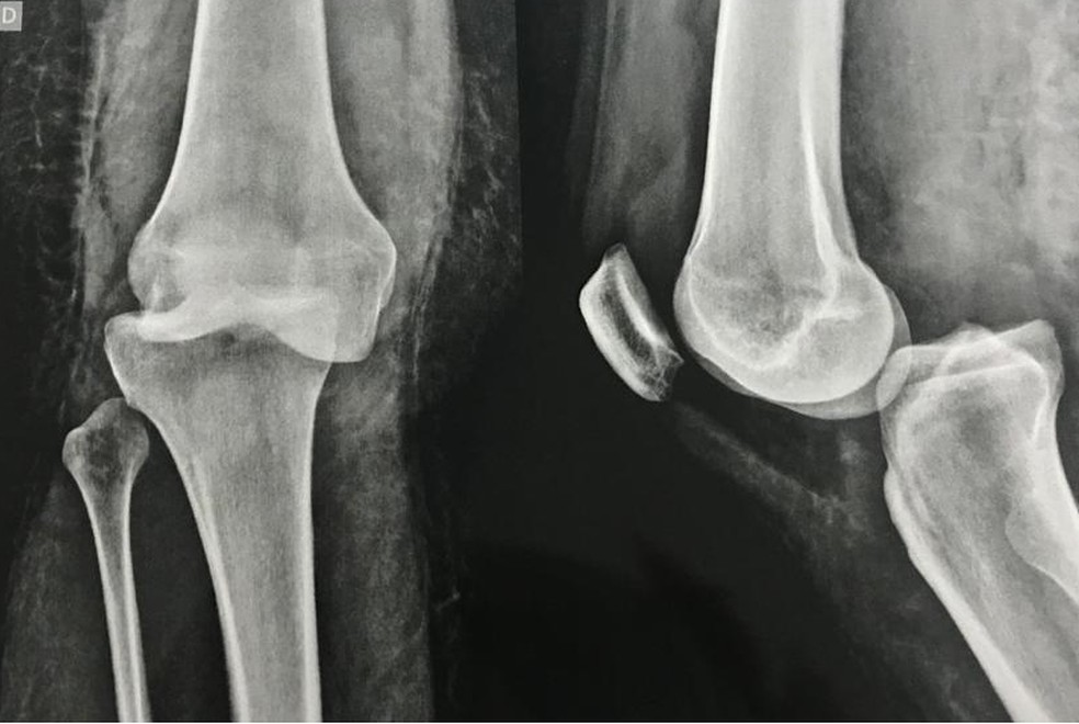 Rafaela Nardi teve uma fratura grave no joelho — Foto: Arquivo pessoal