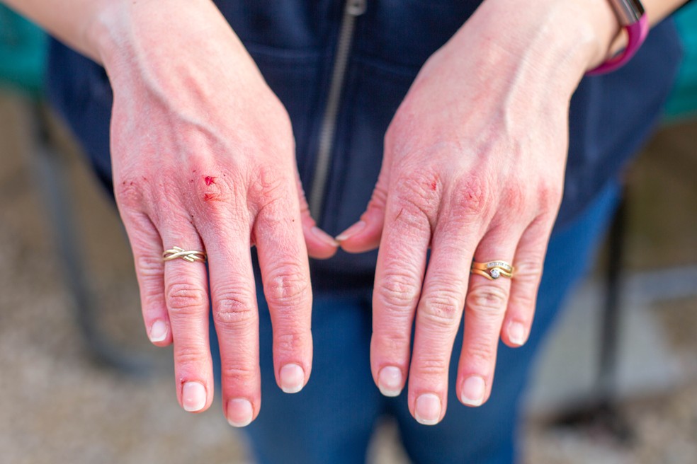 Roer as unhas pode trazer graves consequências: veja os alertas e saiba como tratar — Foto: Unsplash