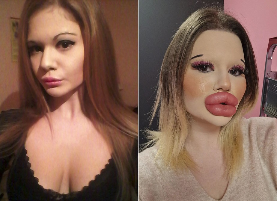 Antes e depois de Andrea Ivanova que, aos 25 anos, já fez mais de 43 procedimentos faciais e 30 injeções de preenchimento nos lábios