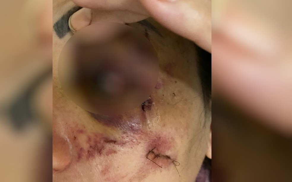 Mulher fica com rosto todo machucado após ser agredida a pauladas pelo companheiro, em Rio Verde — Foto: Reprodução/TV Anhanguera