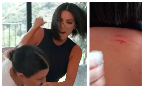 Um dos ferimentos de Kim Kardashian decorrente da briga com a irmã Kourtney Kardashian (Foto: Reprodução)