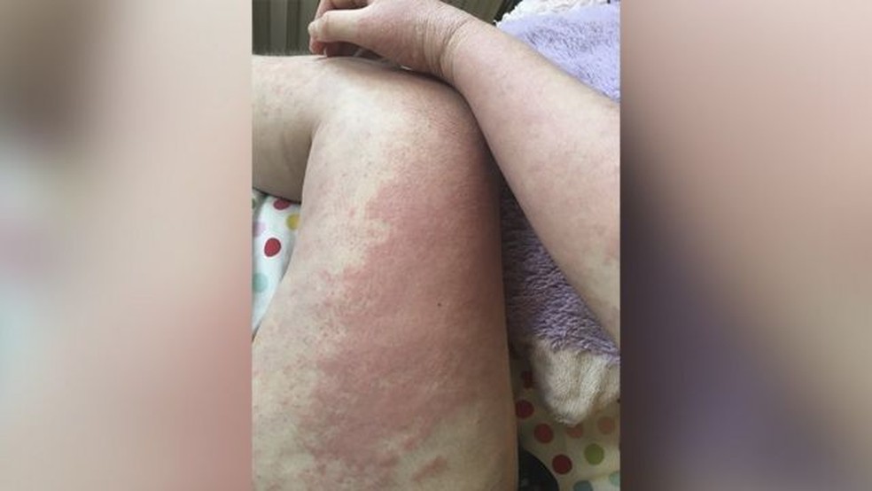 Anna costuma usar roupas grandes para esconder seu eczema — Foto: Anna Byard-Gold via BBC