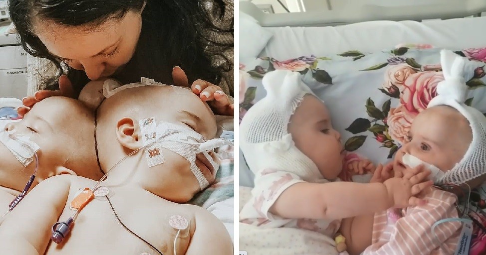 Gêmeas estão se recuperando de cirurgia que durou 24 horas (Foto: Reprodução Instagram)