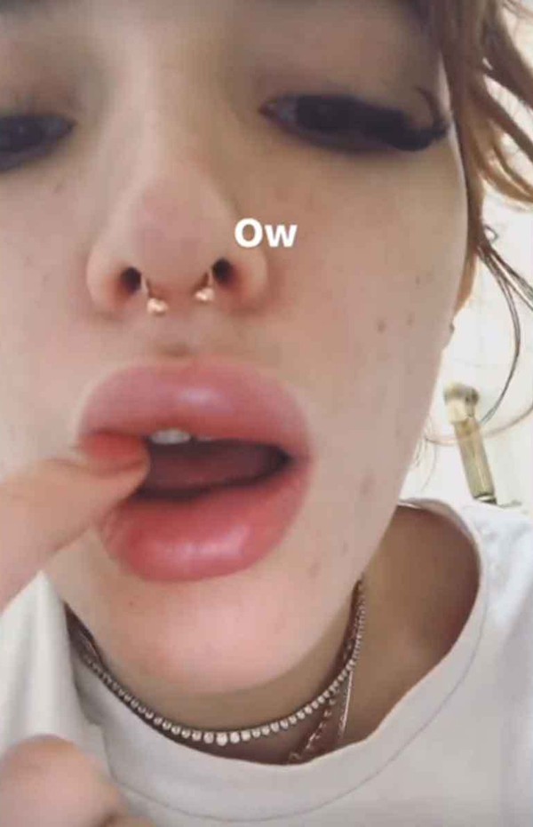 A atriz Bella Thorne com os lábios inchados (Foto: Instagram)