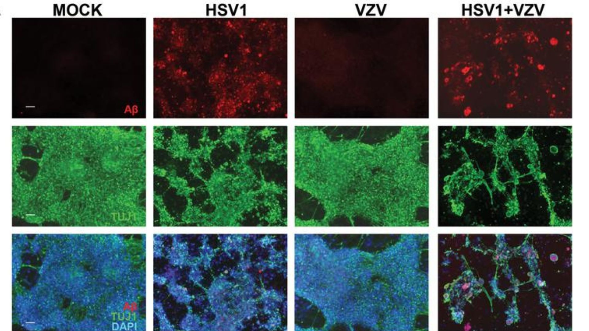 Alzheimer pode ser causado pela interação entre cepa HSV-1 do vírus da herpes comum e o vírus varicela-zóster (VZV) (Foto: Cairns, Dana M.)