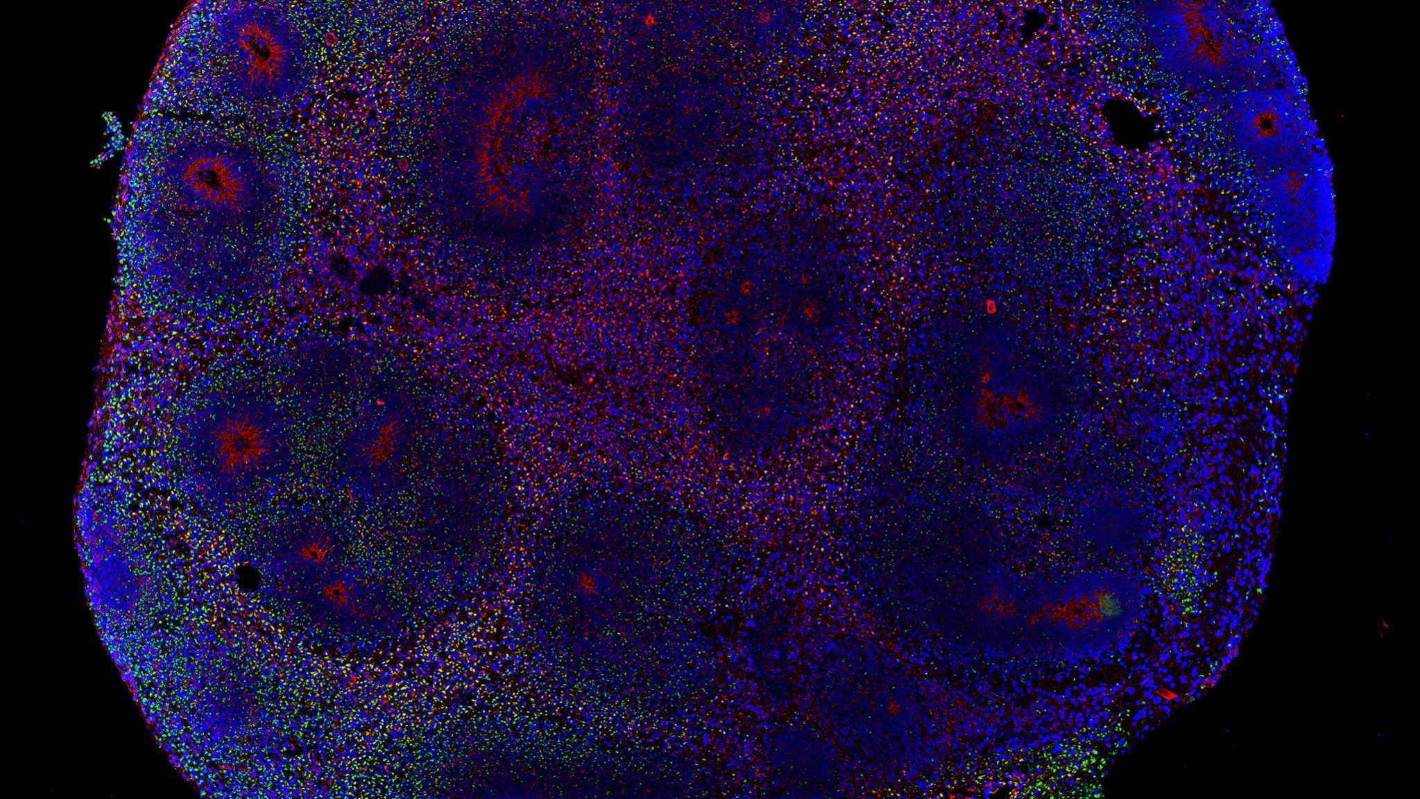 Organoide cerebral (minibrain) infectado com o vírus da zika por 13 dias. Em verde as células infectadas, em vermelho os neurônios e, em azul, os núcleos de todas as células do organoide. (Foto: Divulgação)
