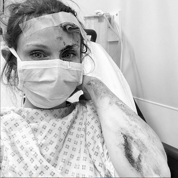 A cantora inglesa Sophie Ellis-Bextor na foto em que expôs seus ferimentos decorrentes de um acidente de bicicleta (Foto: Instagram)