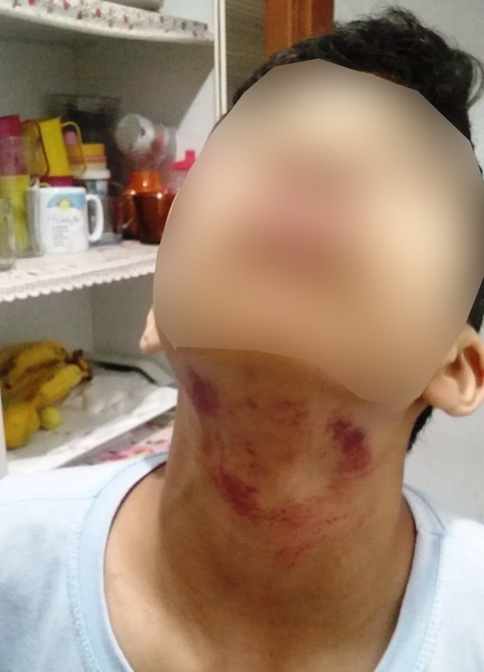 Pescoço de estudante ficou repleto de hematomas após acidente, em Itanhaém (SP) — Foto: Natanael de Olinda/Arquivo Pessoal