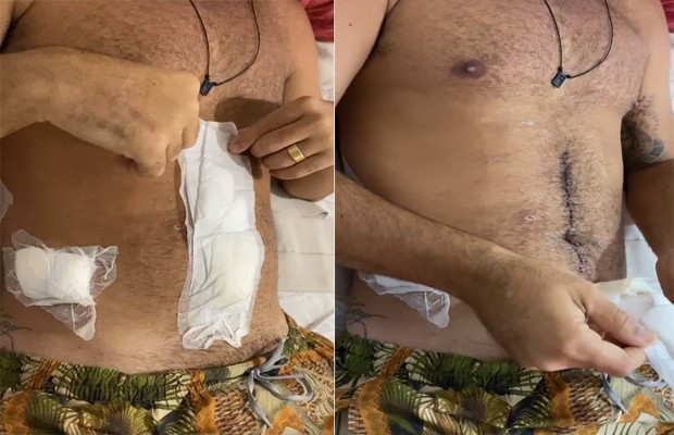 Bruno Miranda, o Borat, mostra cicatrizes de cirurgia e fãs celebram recuperação (Foto: reprodução/instagram)