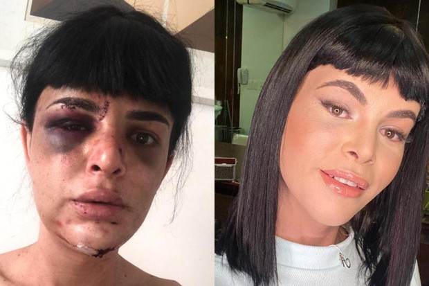 O antes e o depois de Alice Felis após a cirurgia (Foto: Quem/ Ed. Globo)