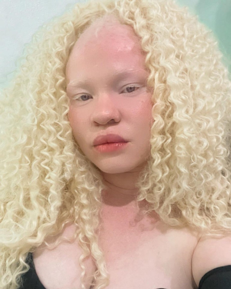 Atriz negra albina fala sobre preconceito: 'Tratam como doença' | Retratos  | Marie Claire