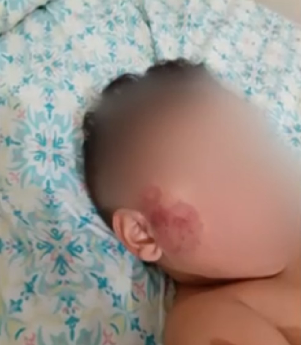 Bebê machucado em creche de Piracicaba — Foto: Reprodução/EPTV