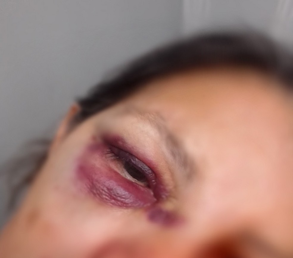 Idosa de 62 anos espancada durante tentativa de assalto no DF ficou com hematomas no rosto — Foto: Arquivo pessoal