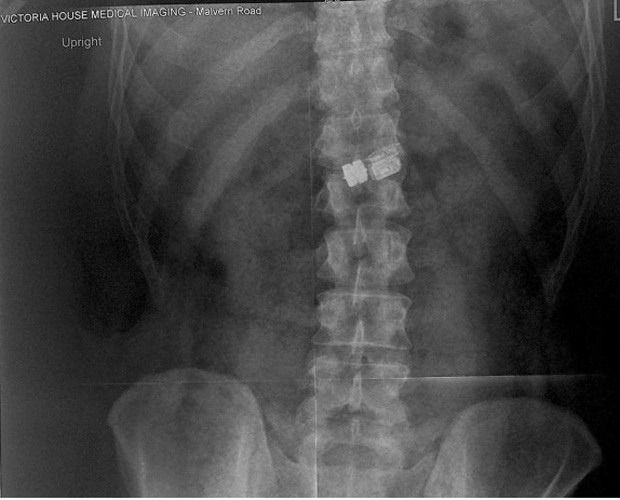 A radiografia de Chris Koch mostra a cápsula engolida (Foto: Reprodução)