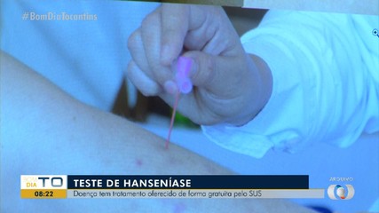 Hanseníase tem teste e tratamento gratuito oferecidos pelo SUS