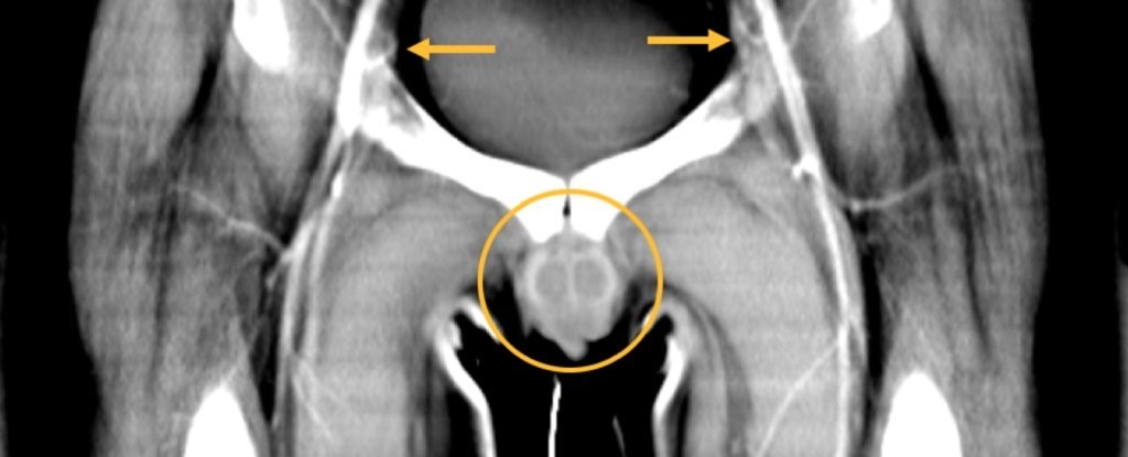 Raio-x antes do procedimento mostra a ausência do pênis do homem  (Foto: Redett et al., NEJM, 2019)