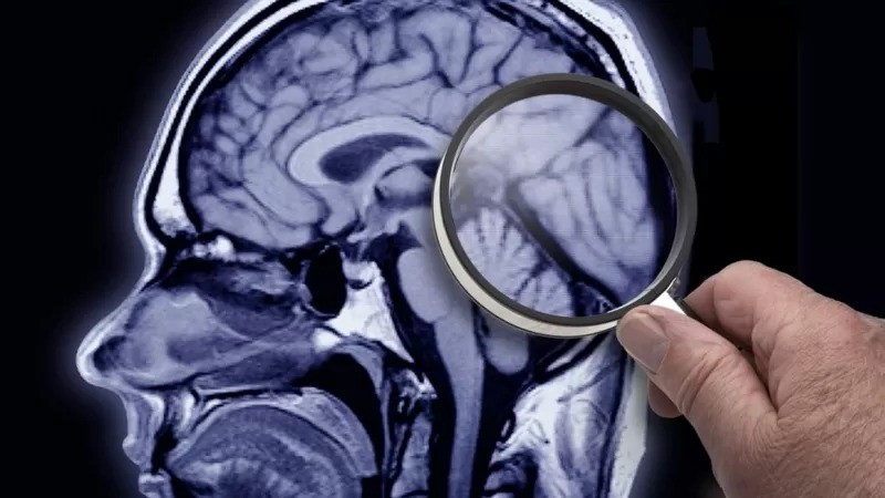 Tentativas de combater Alzheimer focam na redução do declínio cognitivo (Foto: GETTY IMAGES via BBC)