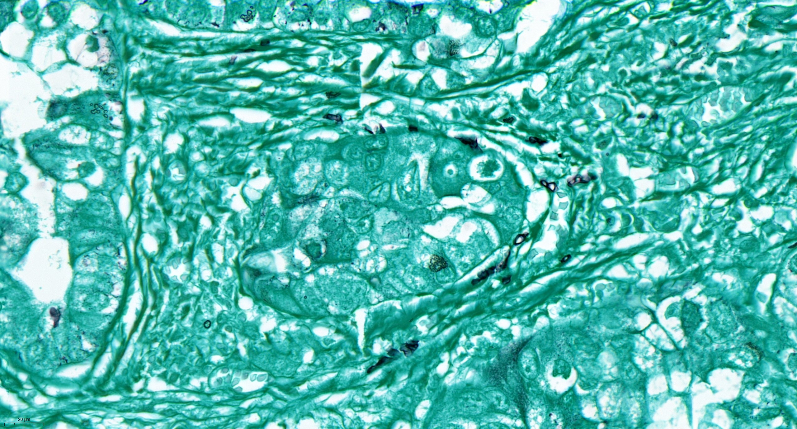 Fungo (em rosa) dentro de células de um tumor de ovário humano (núcleo celular em azul) (Foto: Deborah Nejman and Nancy Gavert)
