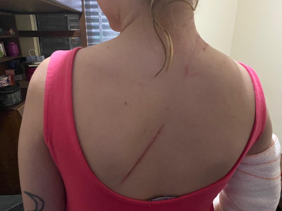 Jovem também teve arranhões nas costas depois do acidente — Foto: Arquivo Pessoal