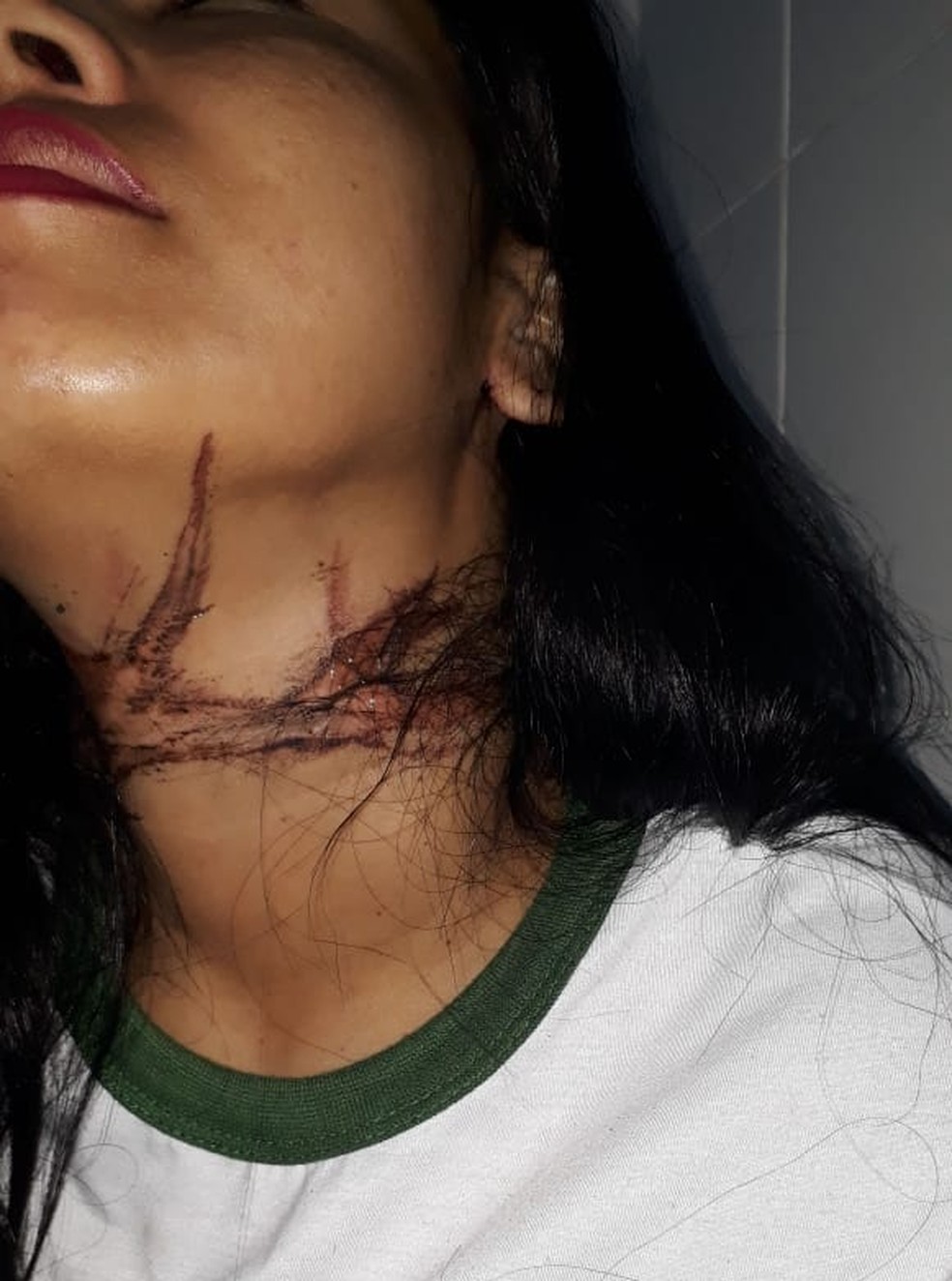 Tatiana Santos sofreu escoriações após ficar enrolada em fio de telefonia no Litoral do Piauí — Foto: Arquivo pessoal