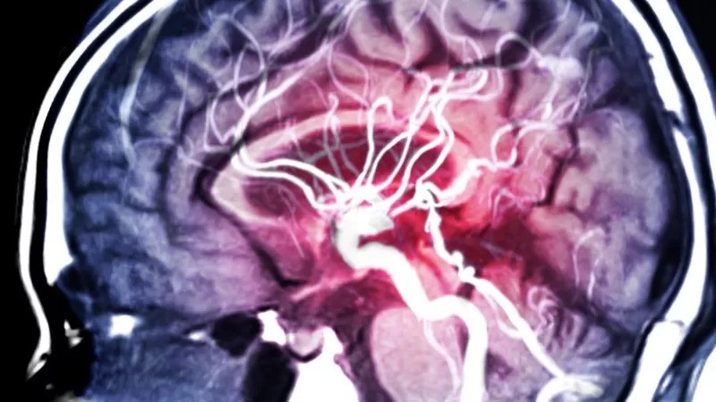 Imagem de ressonância magnética do cérebro humano (Foto: Getty Images via BBC)