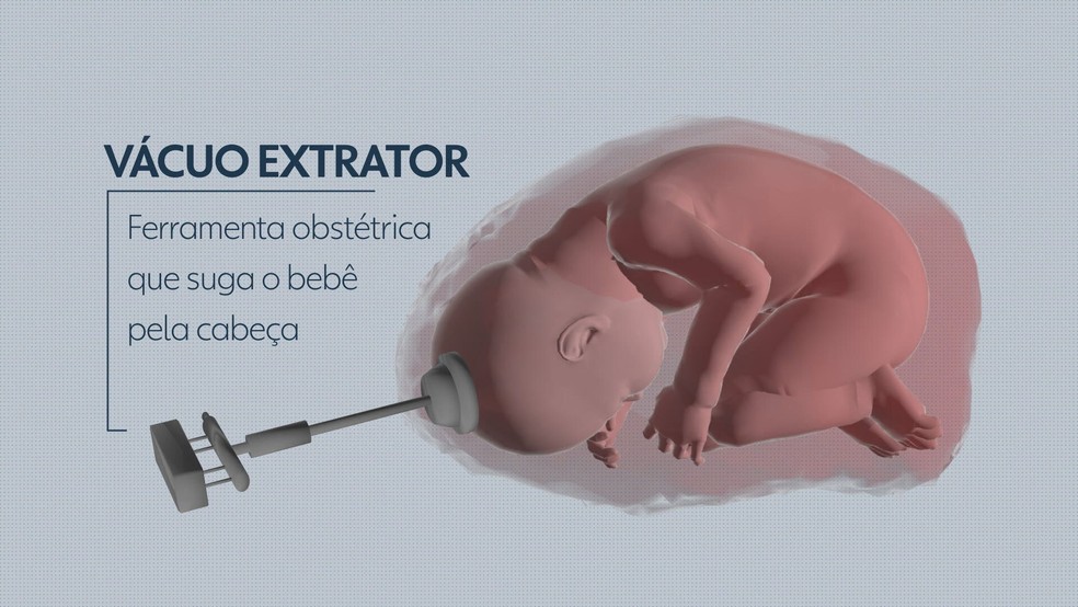 Imagem ilustrativa de um vácuo extrator — Foto: TV Globo/Reprodução