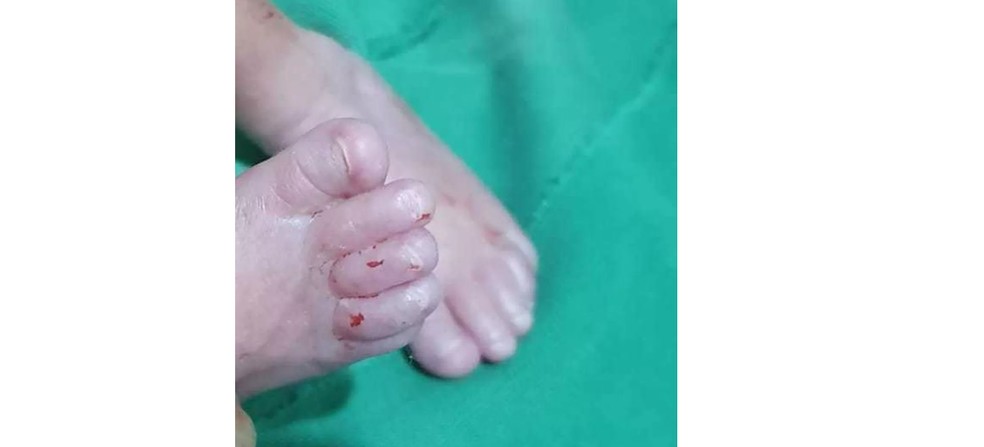 Bebê nasceu prematuro em Ariquemes, RO — Foto: Reprodução