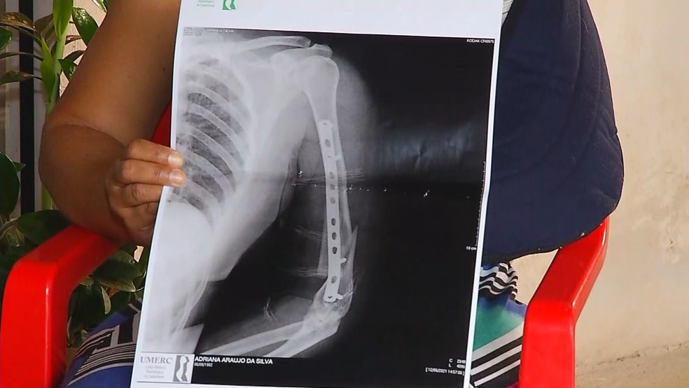 Vítima agredida em Palmares Paulista segurando exame raio x que mostra fratura em braço — Foto: Reprodução/TV TEM 