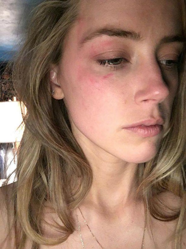 Amber Heard com hematomas no rosto (Foto: Reprodução)