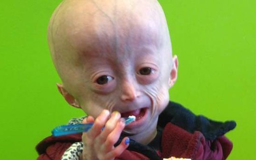 Morre Aos 8 Anos Lucy Parke Garota Com Doenca Rara Que A Envelhecia 8 Vezes Mais Rapido Quem Quem News