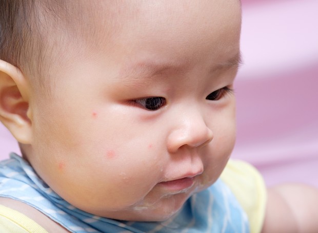 Existem três tipos de brotoejas que podem acometer a pele do bebê (Foto: Thinkstock)