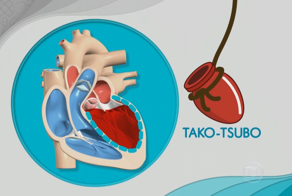 A síndrome do coração partido, ou tako-tsubo, ocorre após um grande estresse emocional, como a perda de uma pessoa próxima ou um assalto (Foto: Reprodução/Bem Estar)