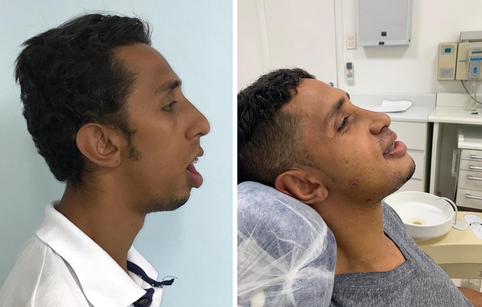 Cleiton Bezerra antes (à esquerda) e depois da cirurgia (à direita) — Foto: Marcelo Quintela