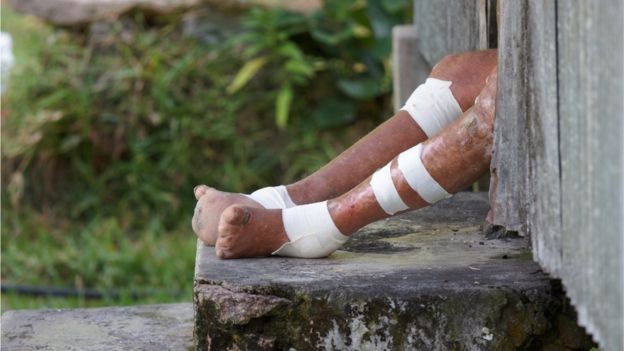 A hanseníase é uma das doenças que atingem milhares de pessoas mas são negligenciadas pela indústria de remédios (Foto: Getty Images via BBC News Brasil)