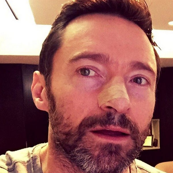 Hugh Jackman mostra o curativo no local onde removeu novo foco de câncer de pele (Foto: Reprodução Instagram)