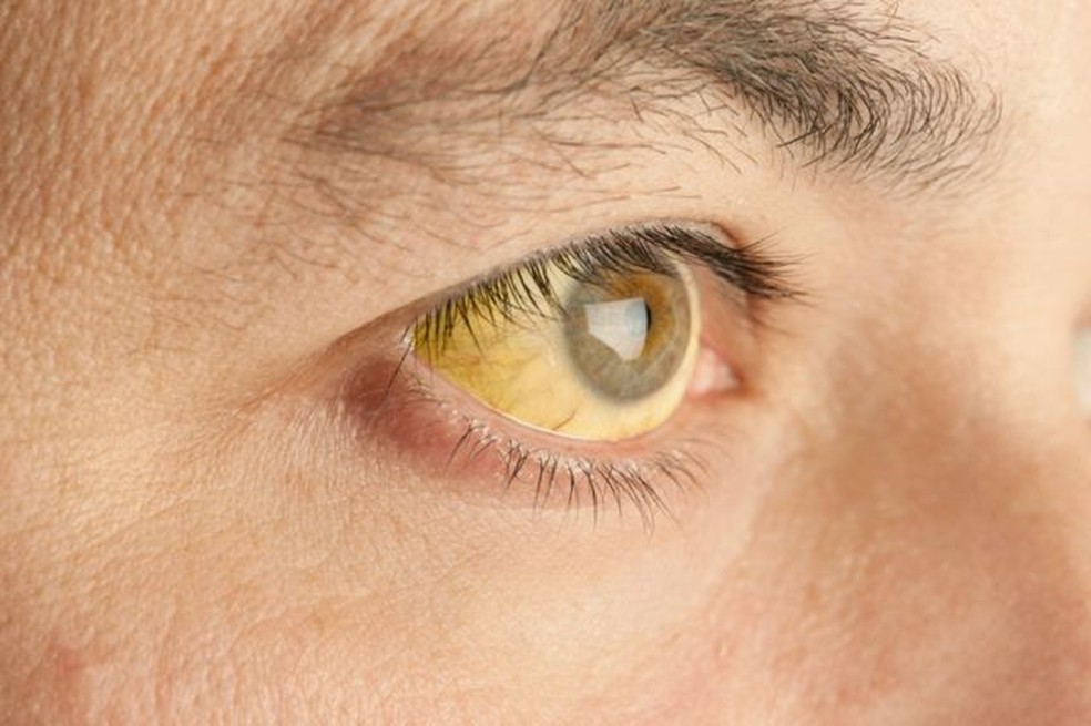 Pele e olhos amarelados são um dos poucos sintomas do câncer de pâncreas. Os incômodos só costumam aparecer num estágio mais avançado da doença. — Foto: Getty Images via BBC