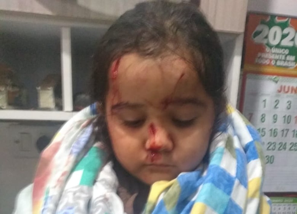 Menina de 3 anos ficou com ferida com a queda de uma telha — Foto: Vanessa Redígolo/Cedida