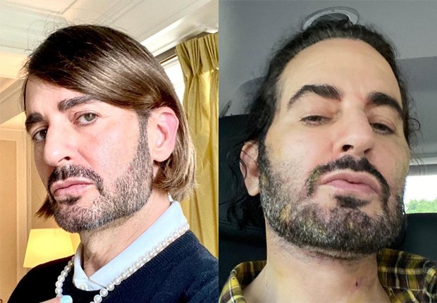 Marc Jacobs antes e seis dias após cirurgia estética (Foto: Reprodução/Instagram)